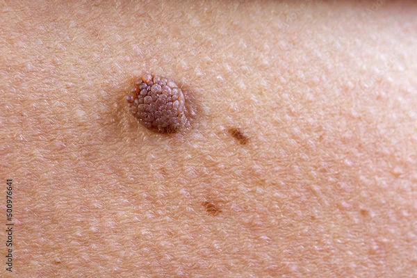 Understanding Basal Cell Carcinoma: A Comprehensive Guide
